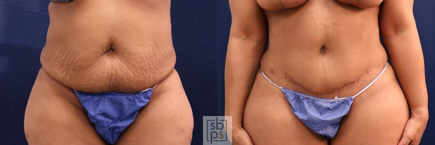 Before & After Tummy Tuck Case 581 Front View in Torrance, CA