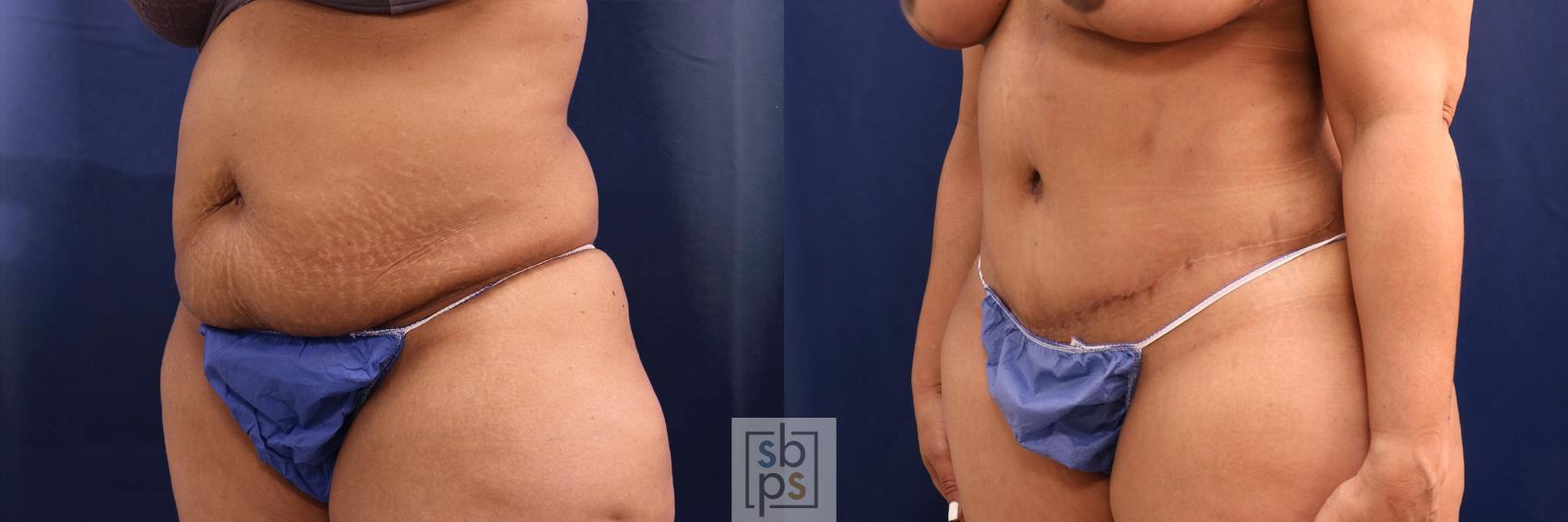 Before & After Tummy Tuck Case 581 Left Oblique View in Torrance, CA