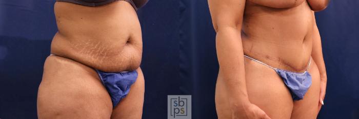 Before & After Tummy Tuck Case 581 Right Oblique View in Torrance, CA