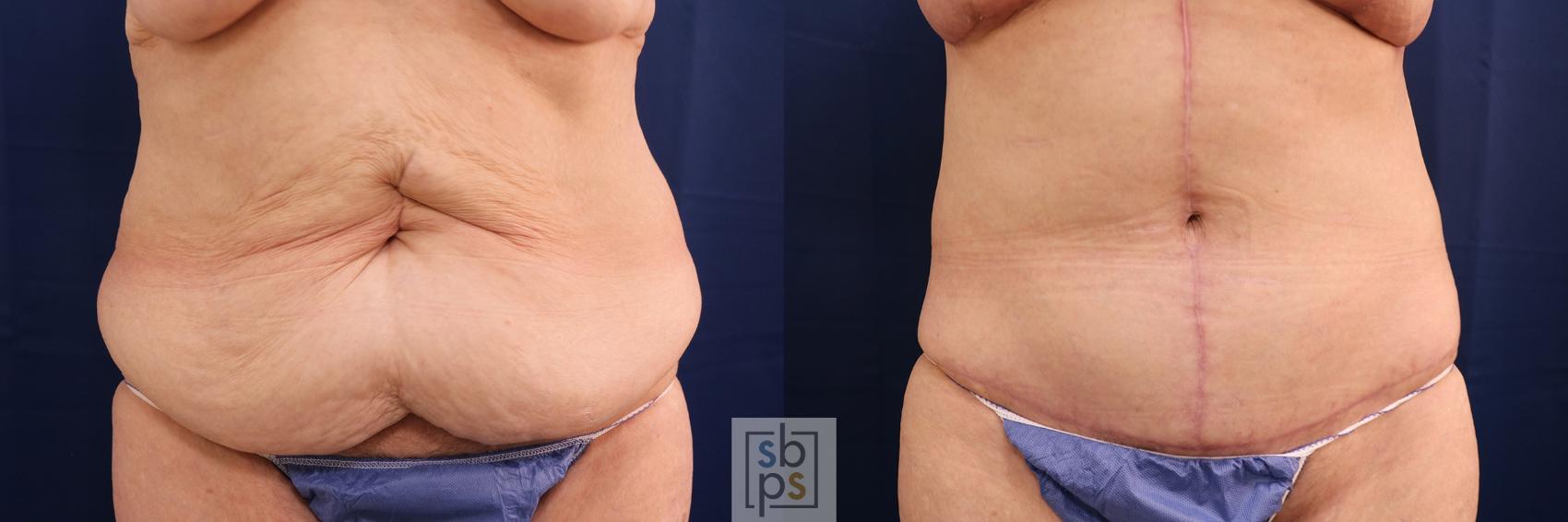 Before & After Tummy Tuck Case 593 Front View in Torrance, CA