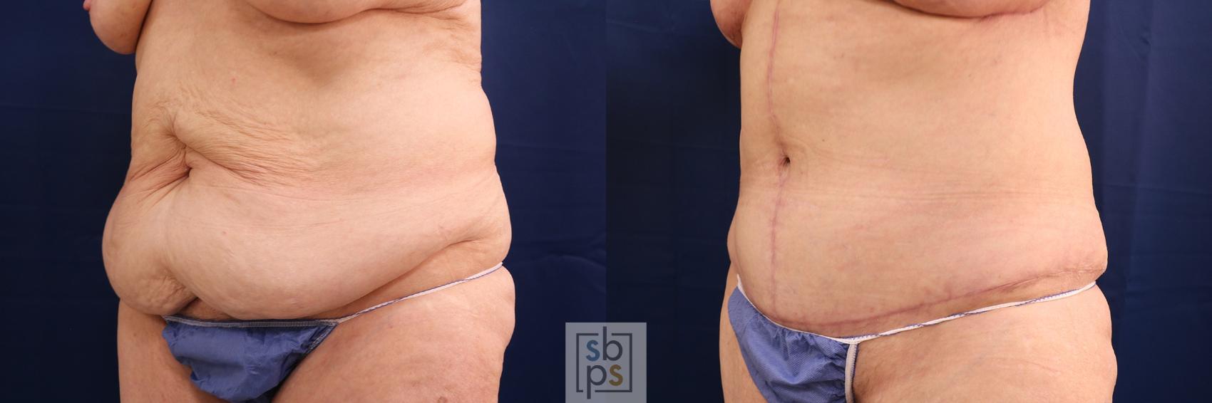 Before & After Tummy Tuck Case 593 Left Oblique View in Torrance & Los Angeles, CA, CA