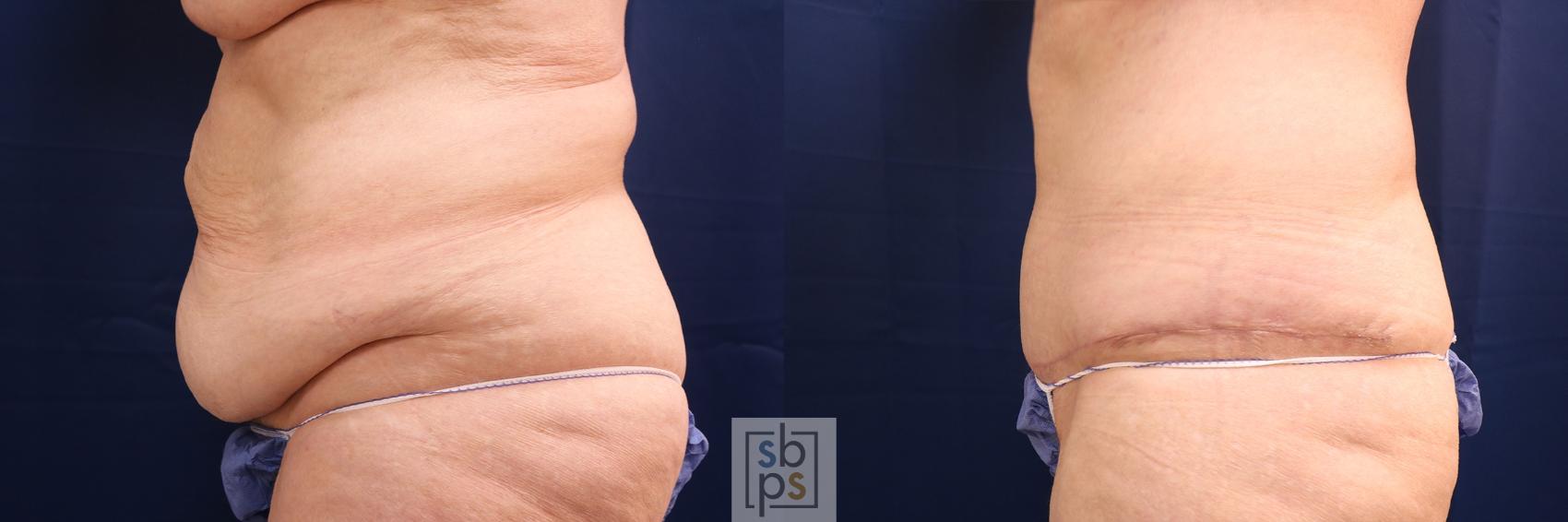 Before & After Tummy Tuck Case 593 Left Side View in Torrance & Los Angeles, CA, CA