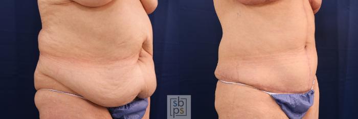 Before & After Tummy Tuck Case 593 Right Oblique View in Torrance, CA