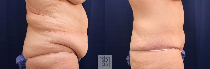 Before & After Tummy Tuck Case 593 Right Side View in Torrance, CA