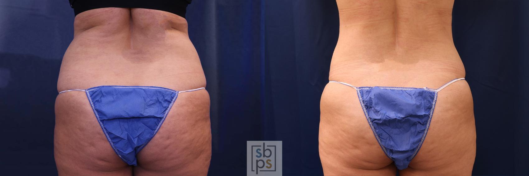 Before & After Tummy Tuck Case 596 Back View in Torrance, CA