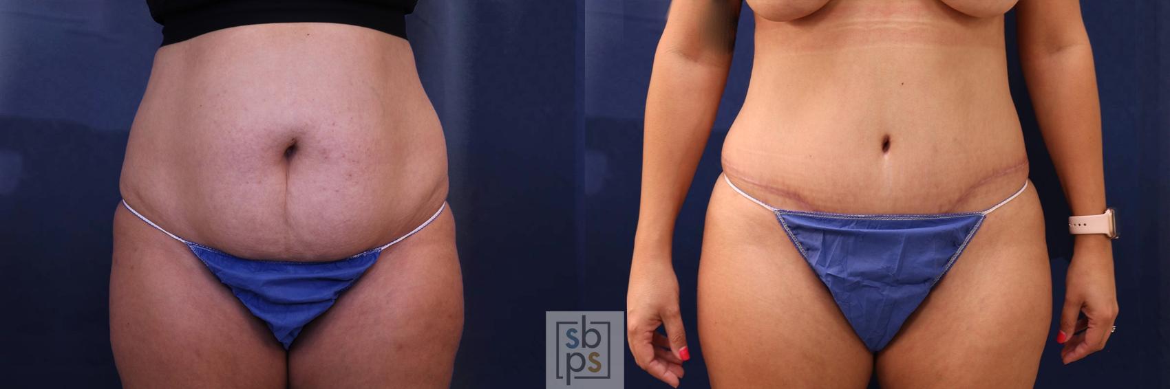 Before & After Tummy Tuck Case 596 Front View in Torrance, CA