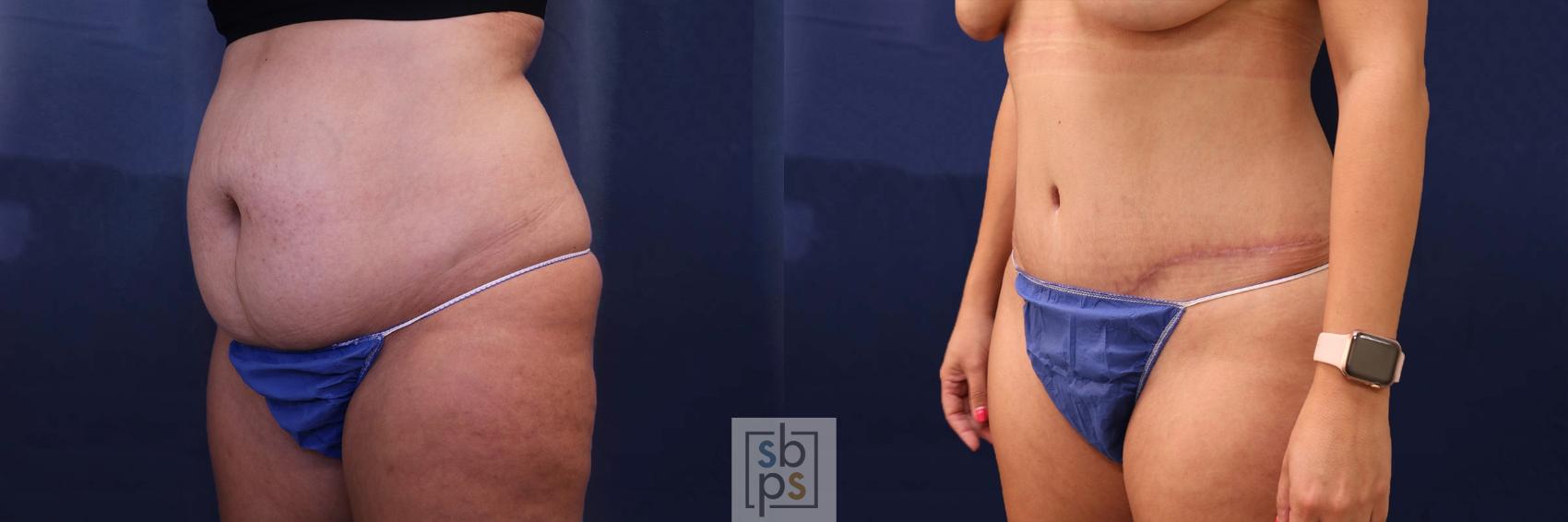 Before & After Tummy Tuck Case 596 Left Oblique View in Torrance, CA
