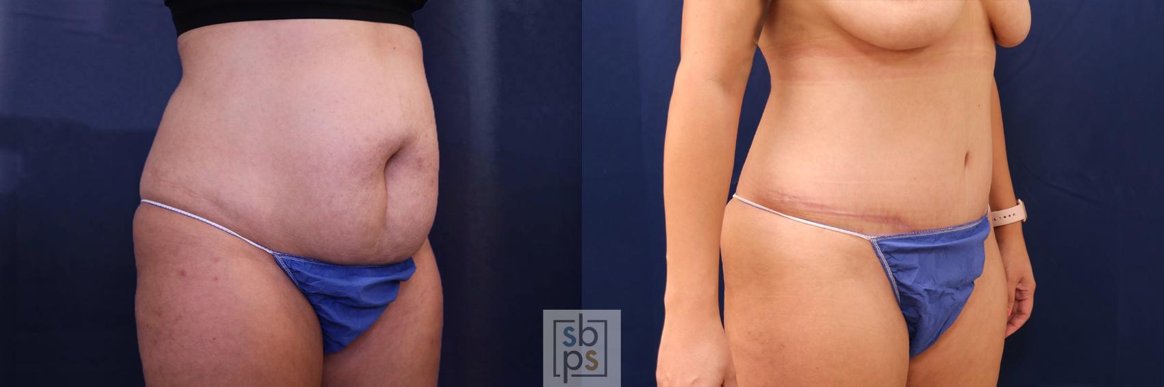 Before & After Tummy Tuck Case 596 Right Oblique View in Torrance, CA