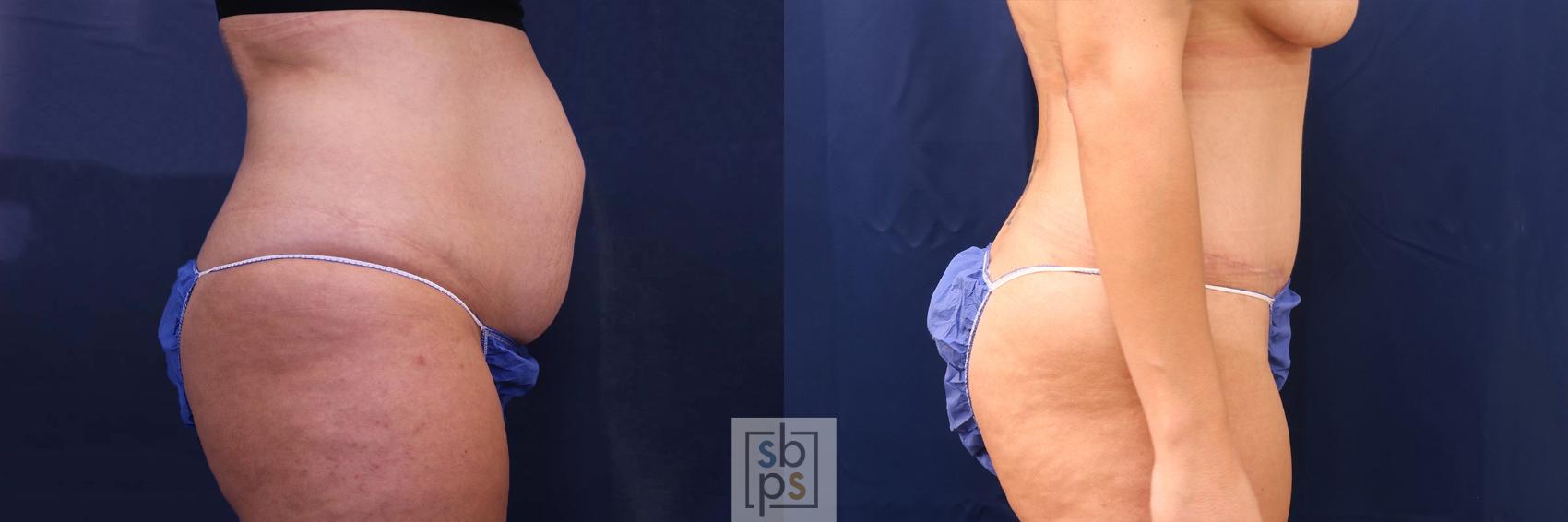 Before & After Tummy Tuck Case 596 Right Side View in Torrance, CA