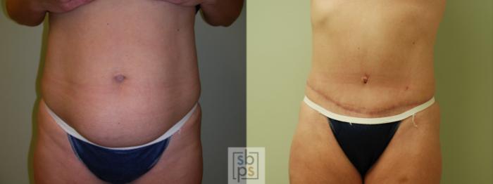 Before & After Tummy Tuck Case 60 View #1 View in Torrance, CA