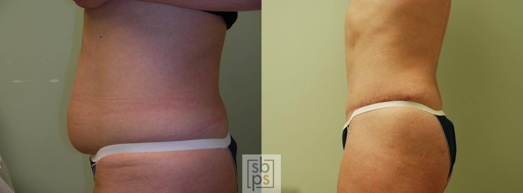 Before & After Tummy Tuck Case 60 View #2 View in Torrance & Los Angeles, CA, CA