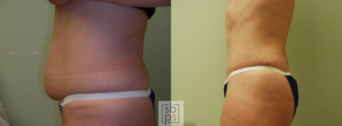 Before & After Tummy Tuck Case 60 View #2 View in Torrance, CA