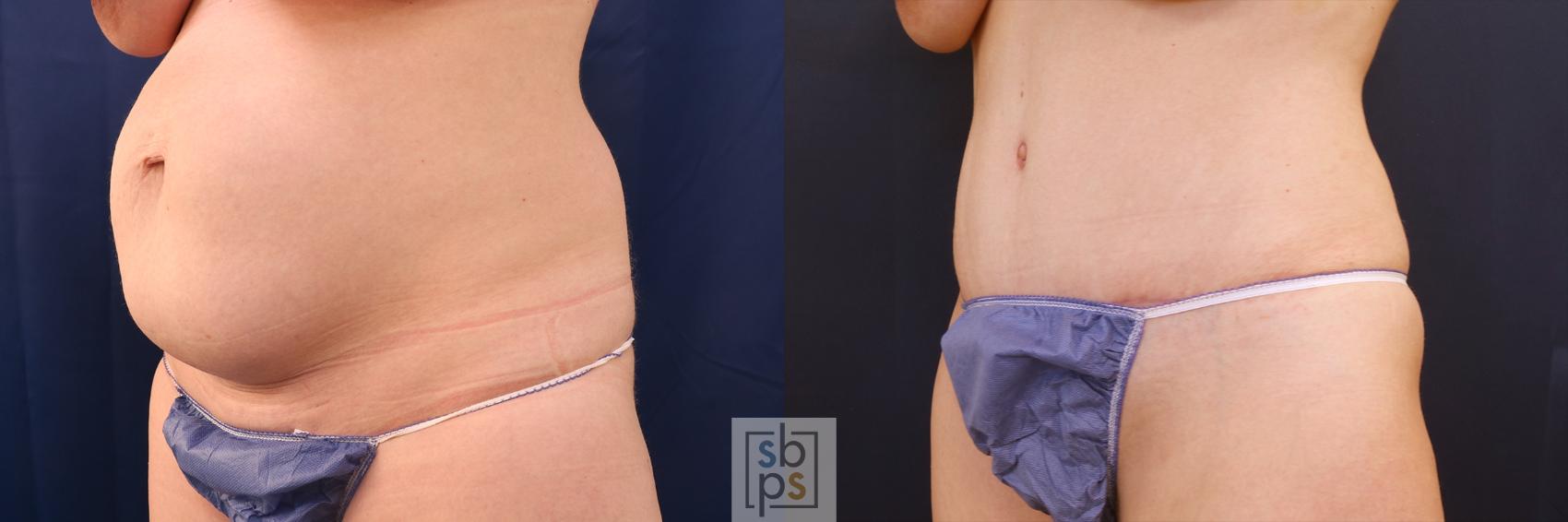 Before & After Tummy Tuck Case 616 Left Oblique View in Torrance, CA