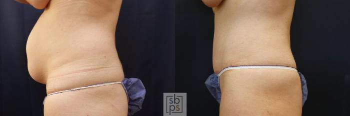 Before & After Tummy Tuck Case 616 Left Side View in Torrance, CA
