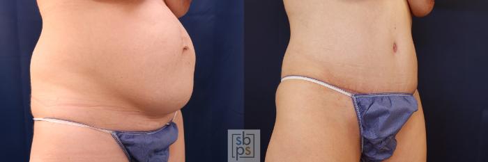 Before & After Tummy Tuck Case 616 Right Oblique View in Torrance, CA