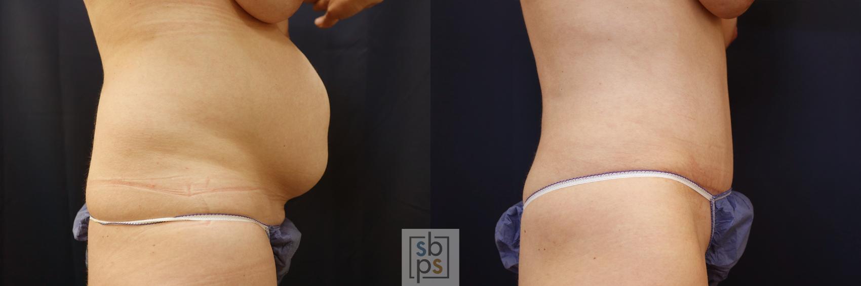 Before & After Tummy Tuck Case 616 Right Side View in Torrance, CA