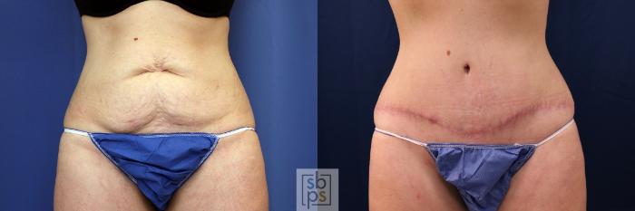 Before & After Tummy Tuck Case 617 Front View in Torrance, CA