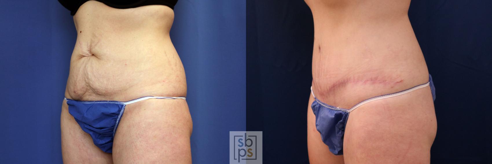 Before & After Tummy Tuck Case 617 Left Oblique View in Torrance & Los Angeles, CA, CA