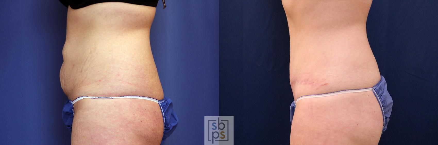 Before & After Tummy Tuck Case 617 Left Side View in Torrance & Los Angeles, CA, CA