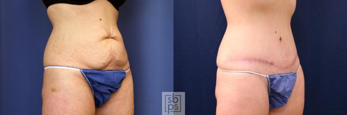 Before & After Tummy Tuck Case 617 Right Oblique View in Torrance, CA