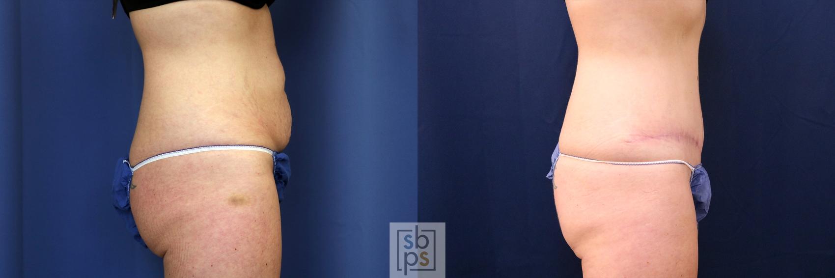 Before & After Tummy Tuck Case 617 Right Side View in Torrance & Los Angeles, CA, CA
