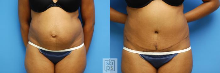 Before & After Tummy Tuck Case 63 View #1 View in Torrance, CA