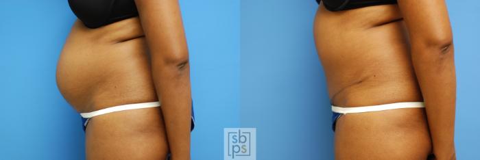 Before & After Tummy Tuck Case 63 View #2 View in Torrance, CA