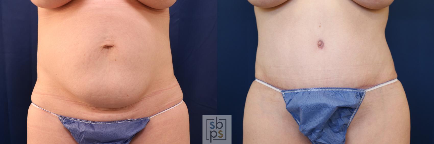 Before & After Tummy Tuck Case 648 Front View in Torrance, CA