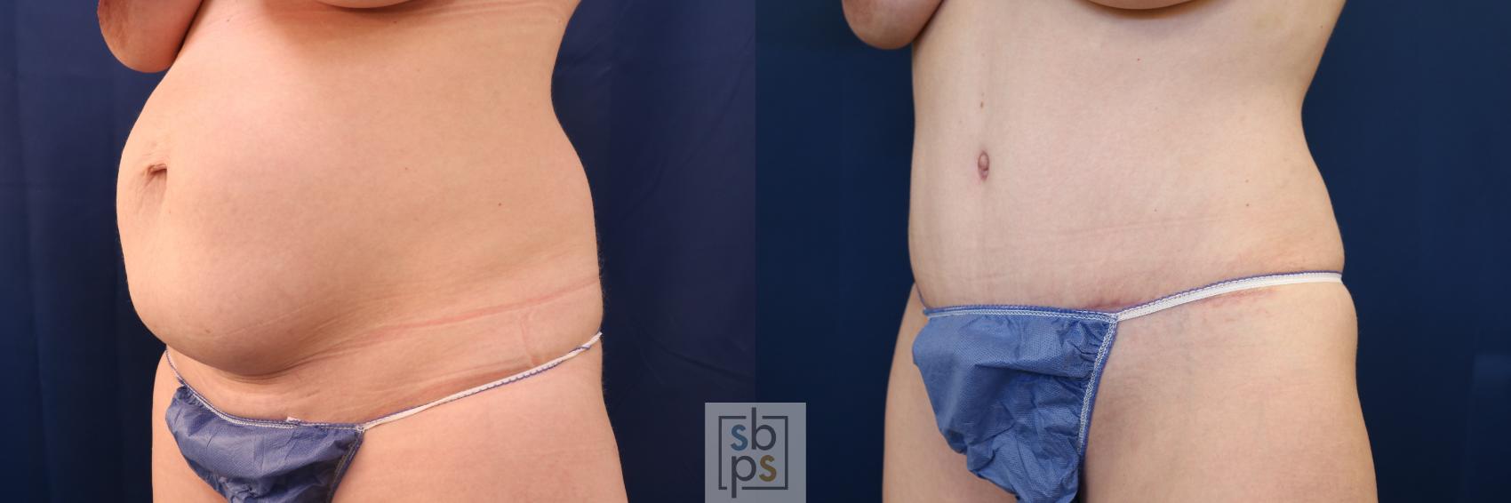 Before & After Tummy Tuck Case 648 Left Oblique View in Los Angeles & Torrance, CA, CA