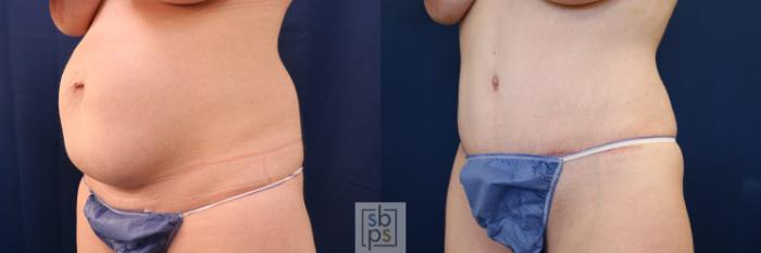 Before & After Tummy Tuck Case 648 Left Oblique View in Torrance, CA