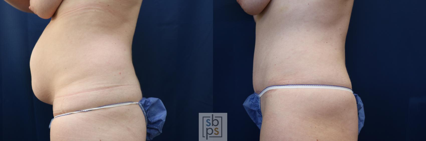 Before & After Tummy Tuck Case 648 Left Side View in Torrance & Los Angeles, CA, CA