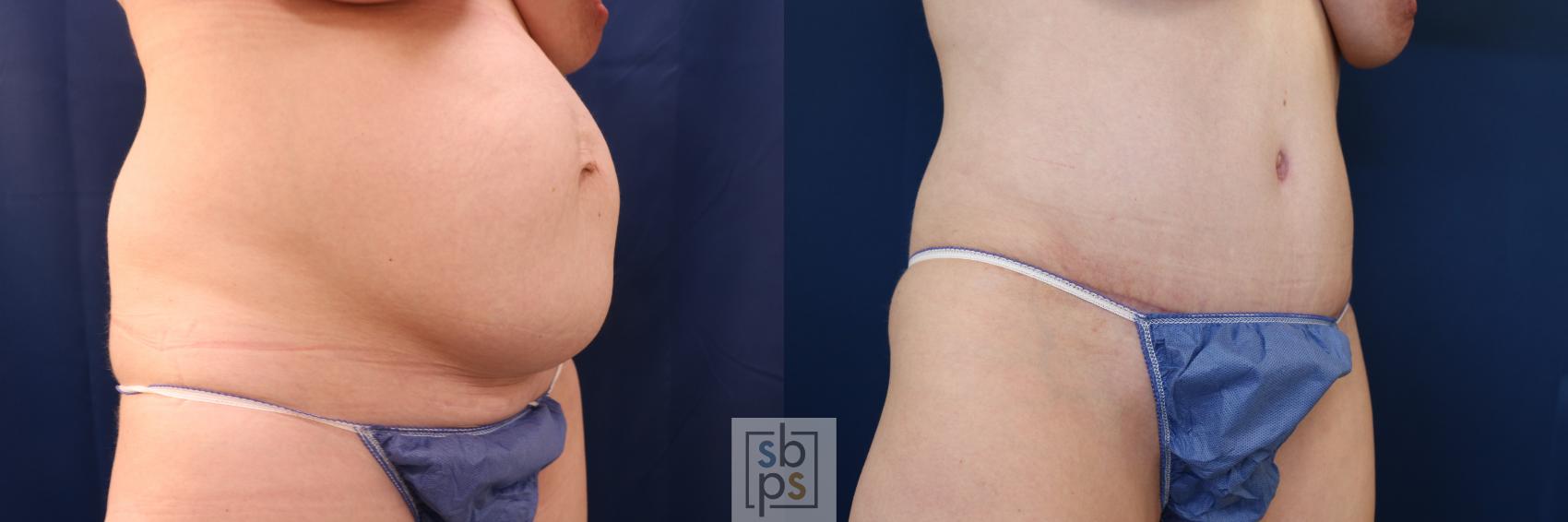 Before & After Tummy Tuck Case 648 Right Oblique View in Torrance & Los Angeles, CA, CA