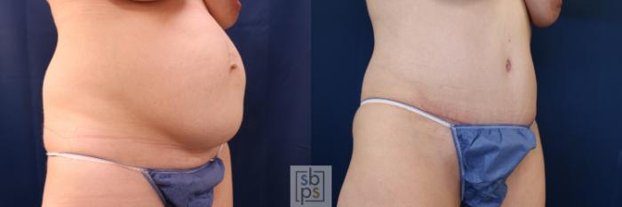Before & After Tummy Tuck Case 648 Right Oblique View in Torrance, CA