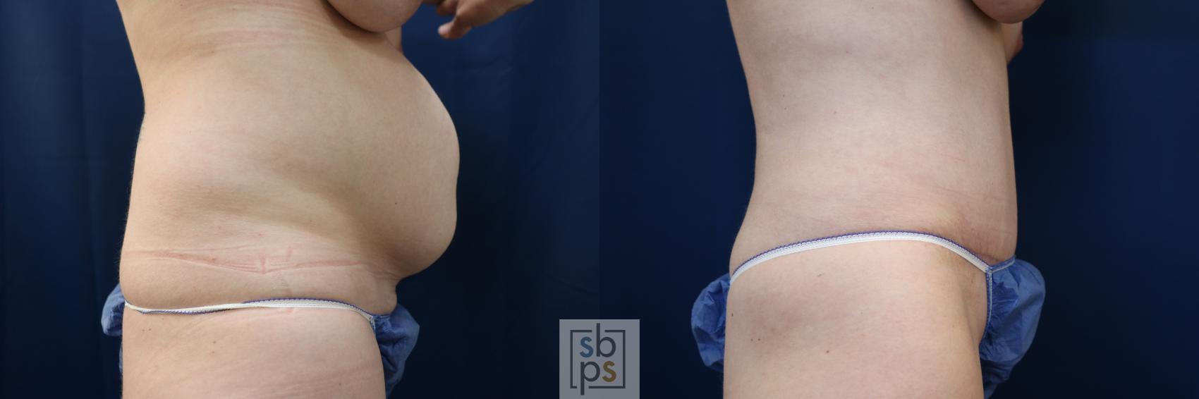 Before & After Tummy Tuck Case 648 Right Side View in Torrance & Los Angeles, CA, CA