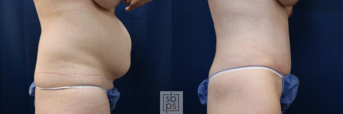 Before & After Tummy Tuck Case 648 Right Side View in Torrance, CA