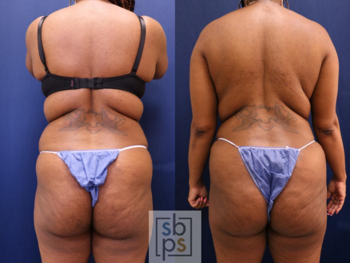 Before & After Liposuction Case 652 Back View in Torrance, CA