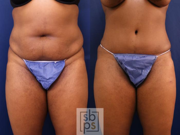 Before & After Liposuction Case 652 Front View in Torrance, CA