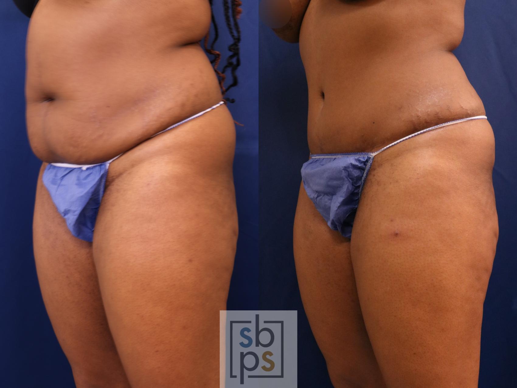 Before & After Tummy Tuck Case 652 Left Oblique View in Los Angeles & Torrance, CA, CA