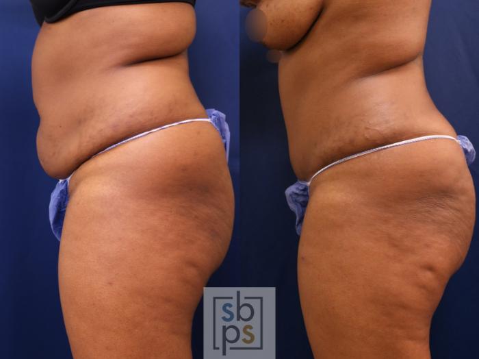 Before & After Liposuction Case 652 Left Side View in Torrance, CA