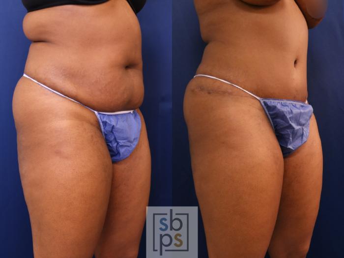 Before & After Liposuction Case 652 Right Oblique View in Torrance, CA