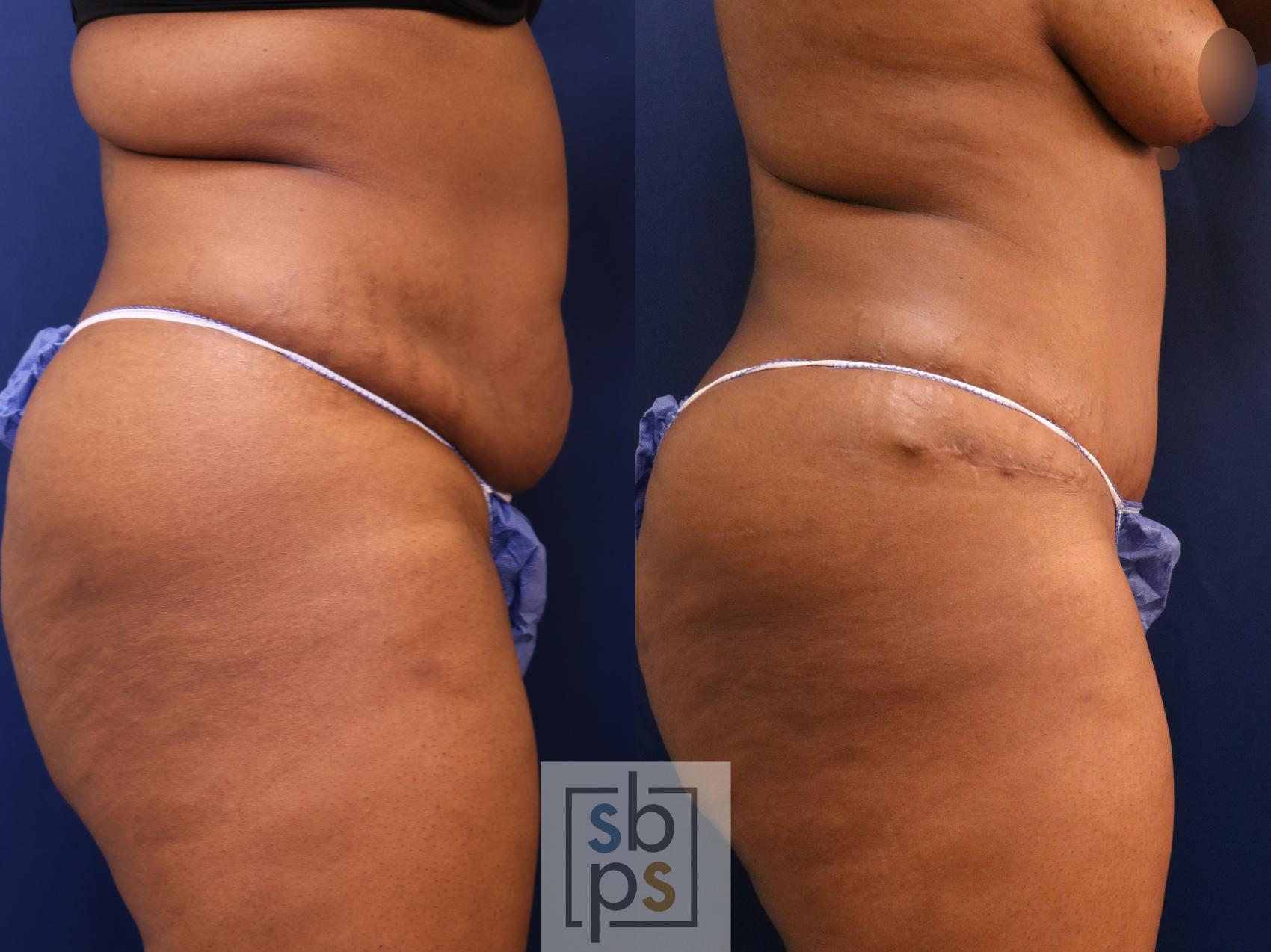Before & After Tummy Tuck Case 652 Right Side View in Torrance, CA