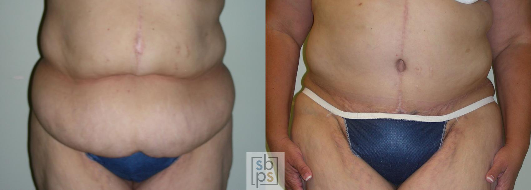 Before & After Tummy Tuck Case 66 View #1 View in Torrance, CA