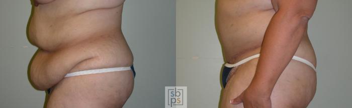 Before & After Tummy Tuck Case 66 View #2 View in Torrance, CA