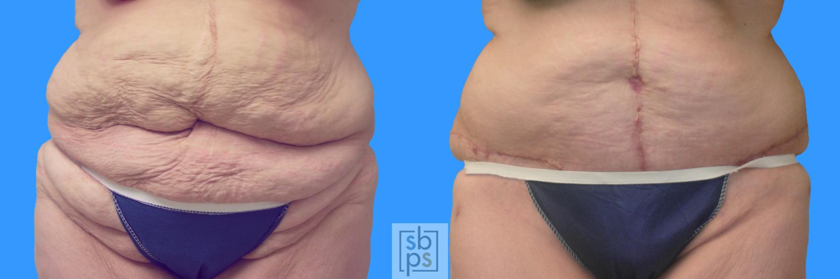Before & After After Massive Weight Loss Case 67 View #1 View in Torrance, CA