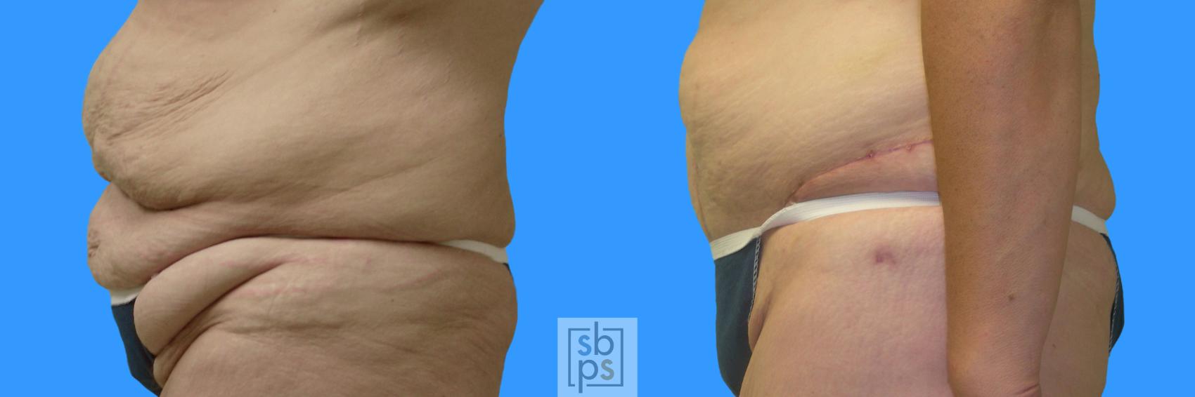 Before & After Tummy Tuck Case 67 View #2 View in Torrance & Los Angeles, CA, CA