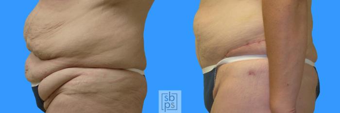 Before & After Tummy Tuck Case 67 View #2 View in Torrance, CA