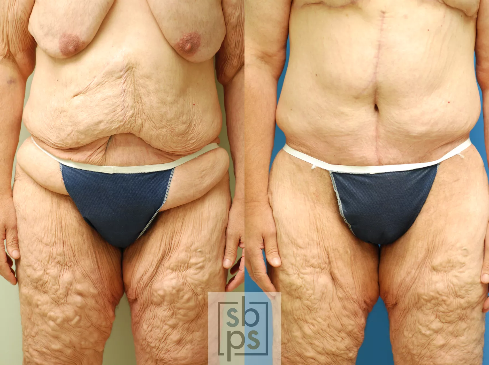 Tummy Tuck Before and After Pictures Case 69, Torrance, CA