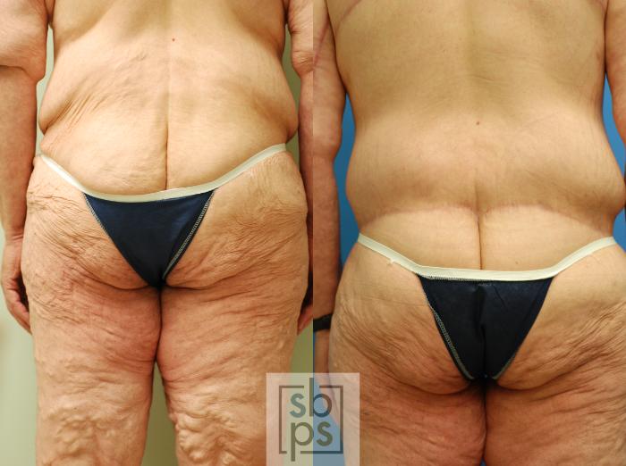Tummy Tuck Revision Surgery Before & After Photo Gallery - Patient #1