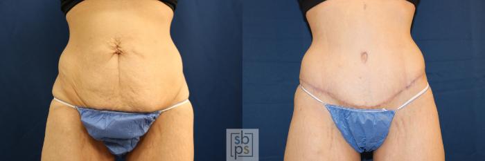 Before & After Tummy Tuck Case 692 Front View in Torrance, CA