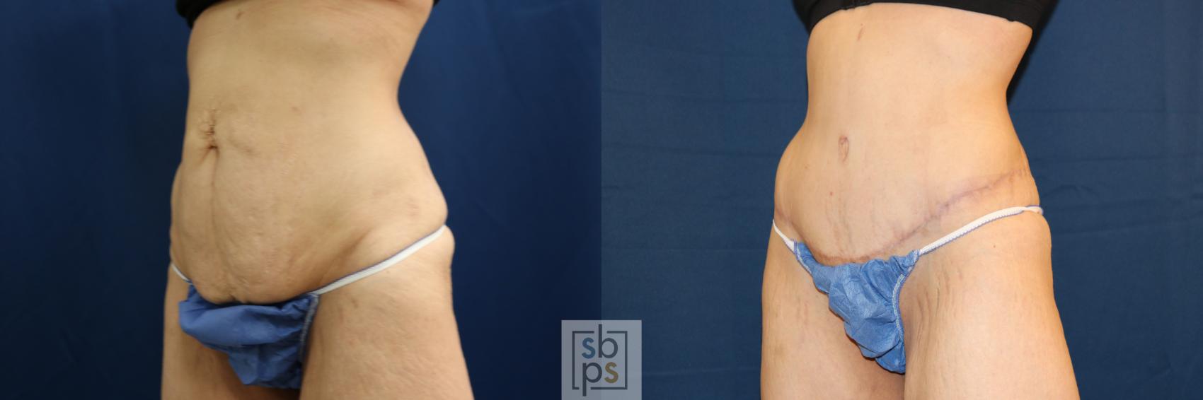 Before & After Tummy Tuck Case 692 Left Oblique View in Torrance & Los Angeles, CA, CA